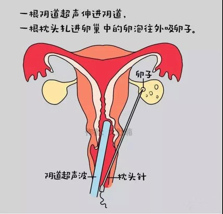 有偿捐卵是什么？别为了钱作践自己第10张